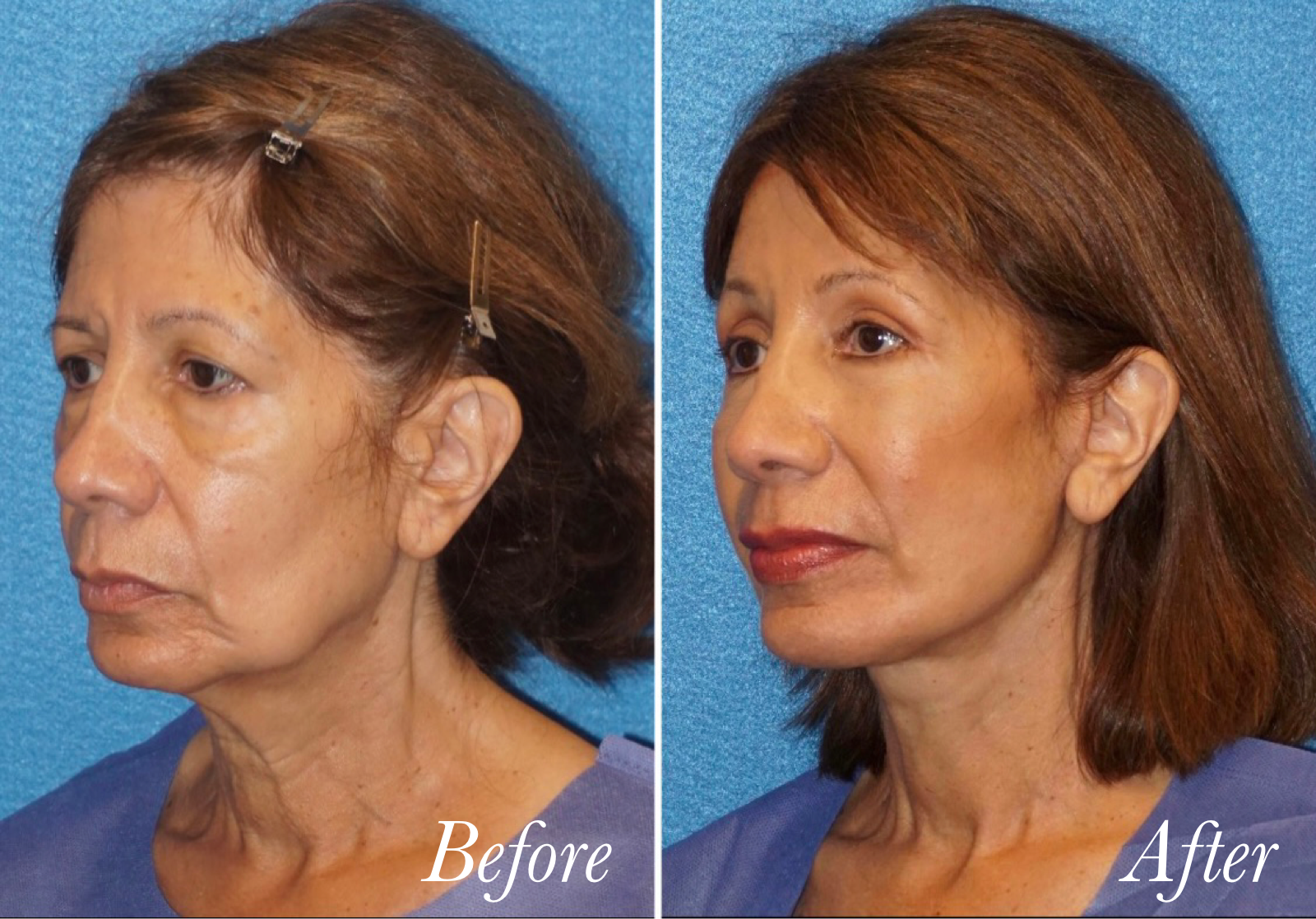 Plastic surgery before and after photo against a blue background.