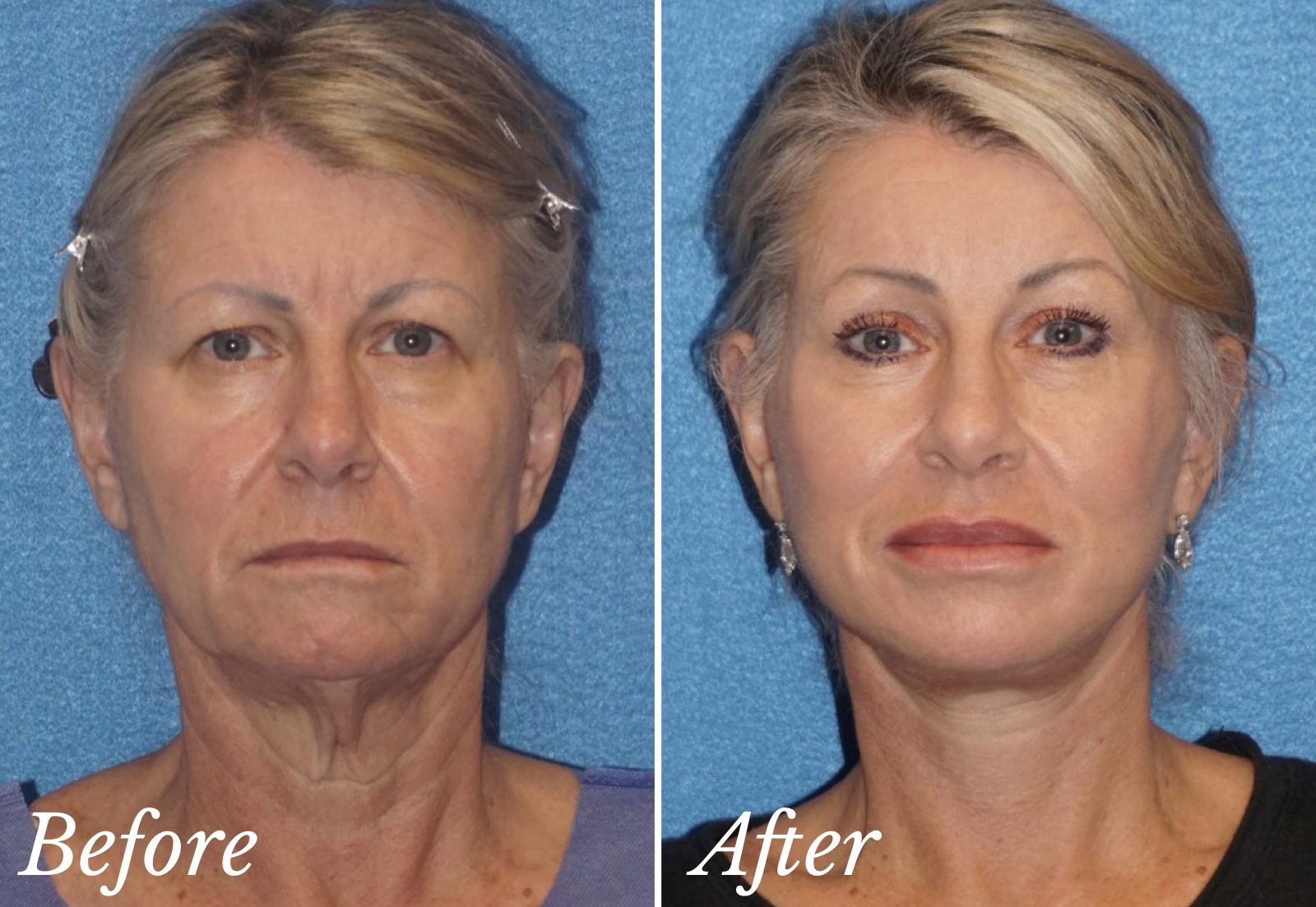 Plastic surgery before and after photo against a blue background.
